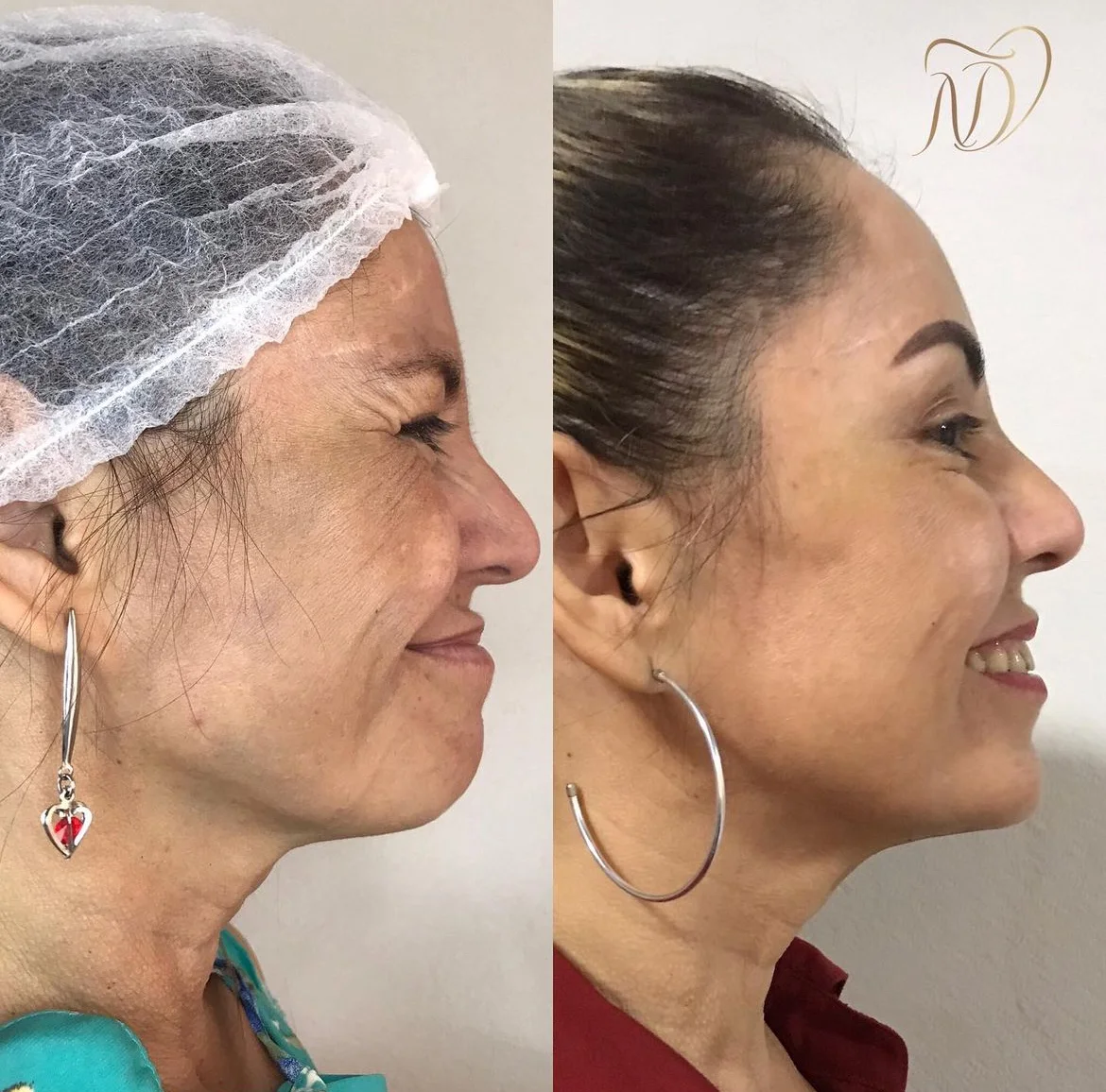 Imagem Botox 1
