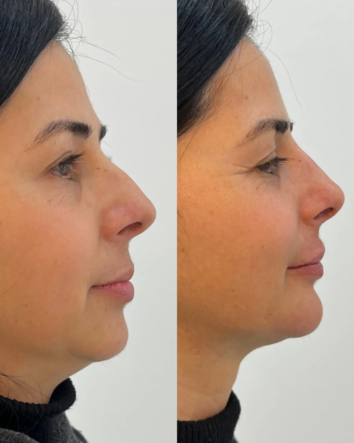 Imagem Perfiloplastia 1