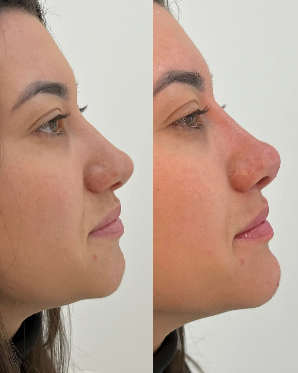 Imagem Perfiloplastia 2