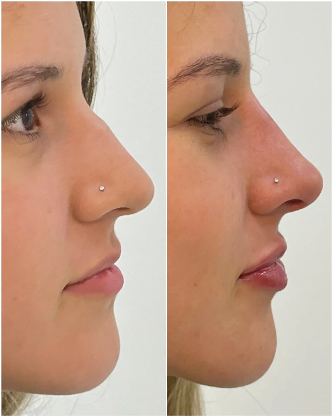 Imagem Perfiloplastia 3